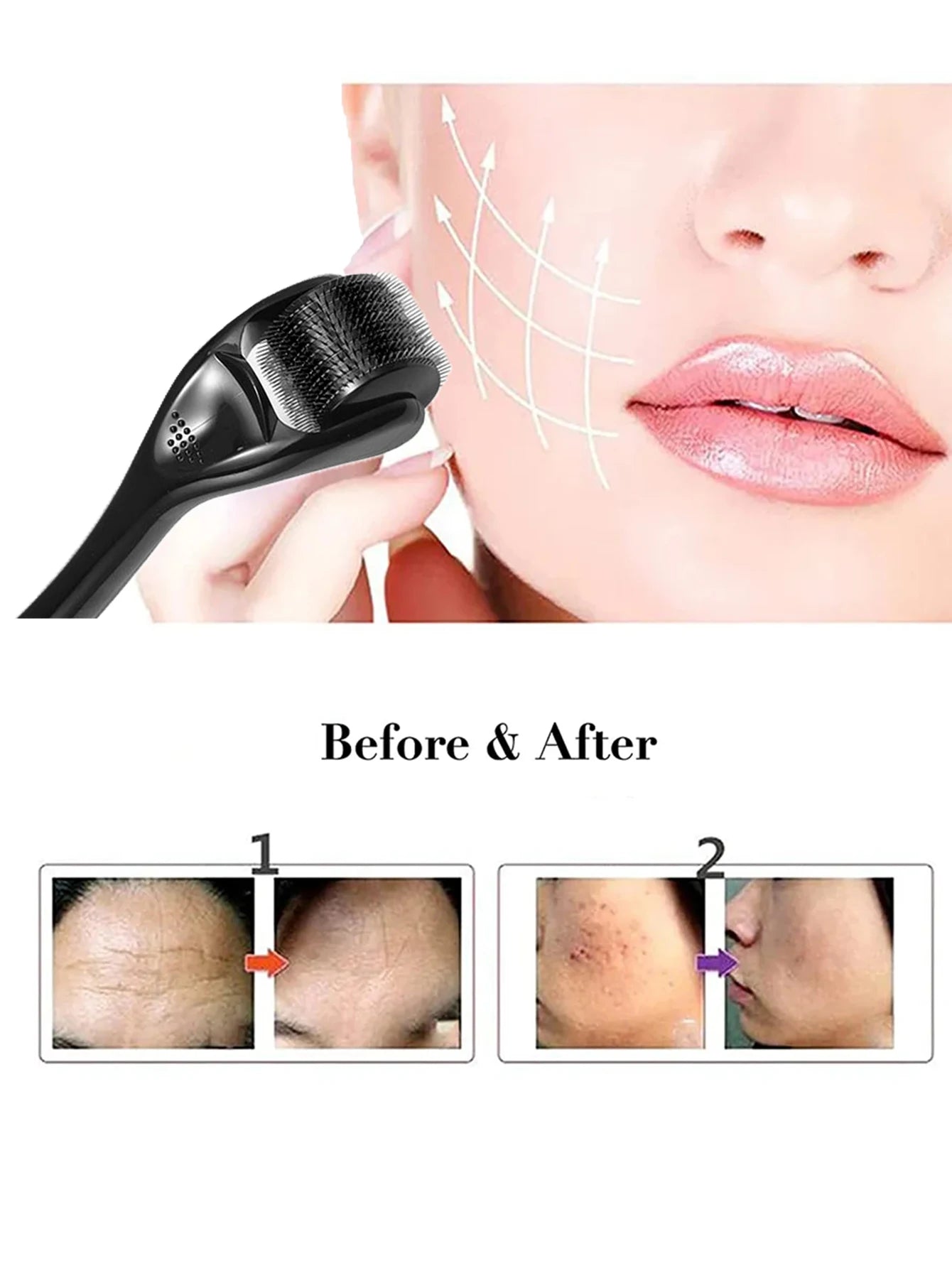 Rodillo Dermaroller 540 Microagujas de Titanio — Cuidado Facial Profesional en Casa